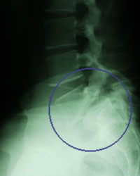 X-Ray showing Spondylolisthesis